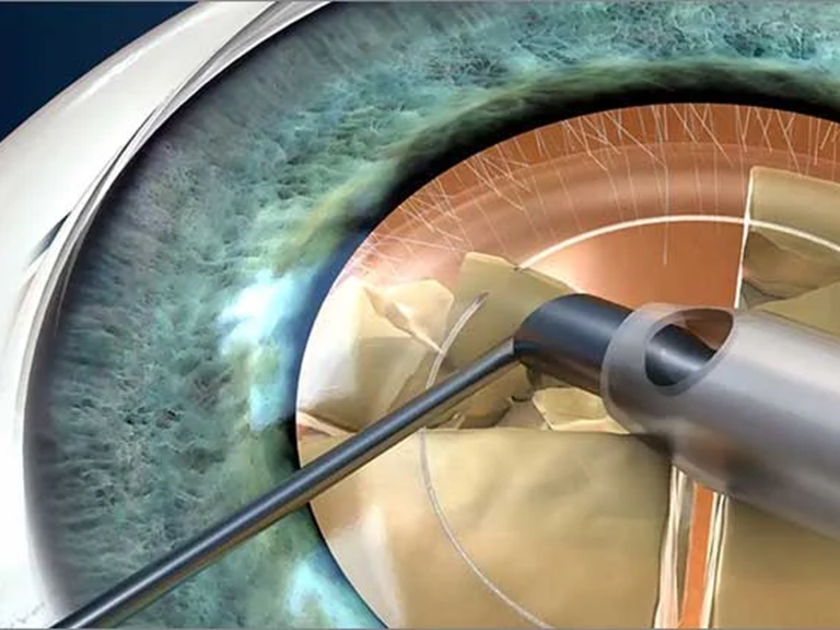 Phacoemulsification Cataract Surgery