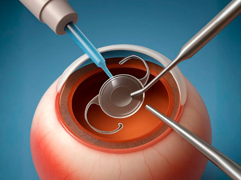 Premium Multifocal & Trifocal IOL Surgery
