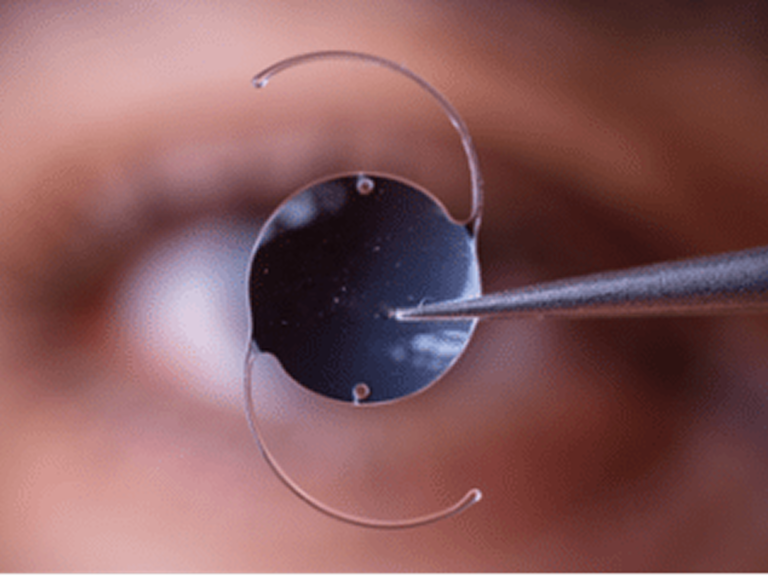 Toric IOL Cataract Surgery