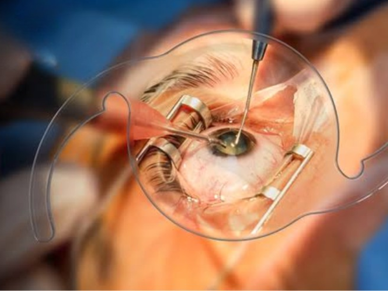 Advanced & High-Risk Cataract Surgery