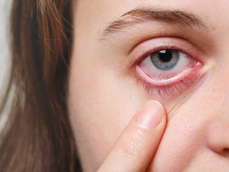 Keratoconus
