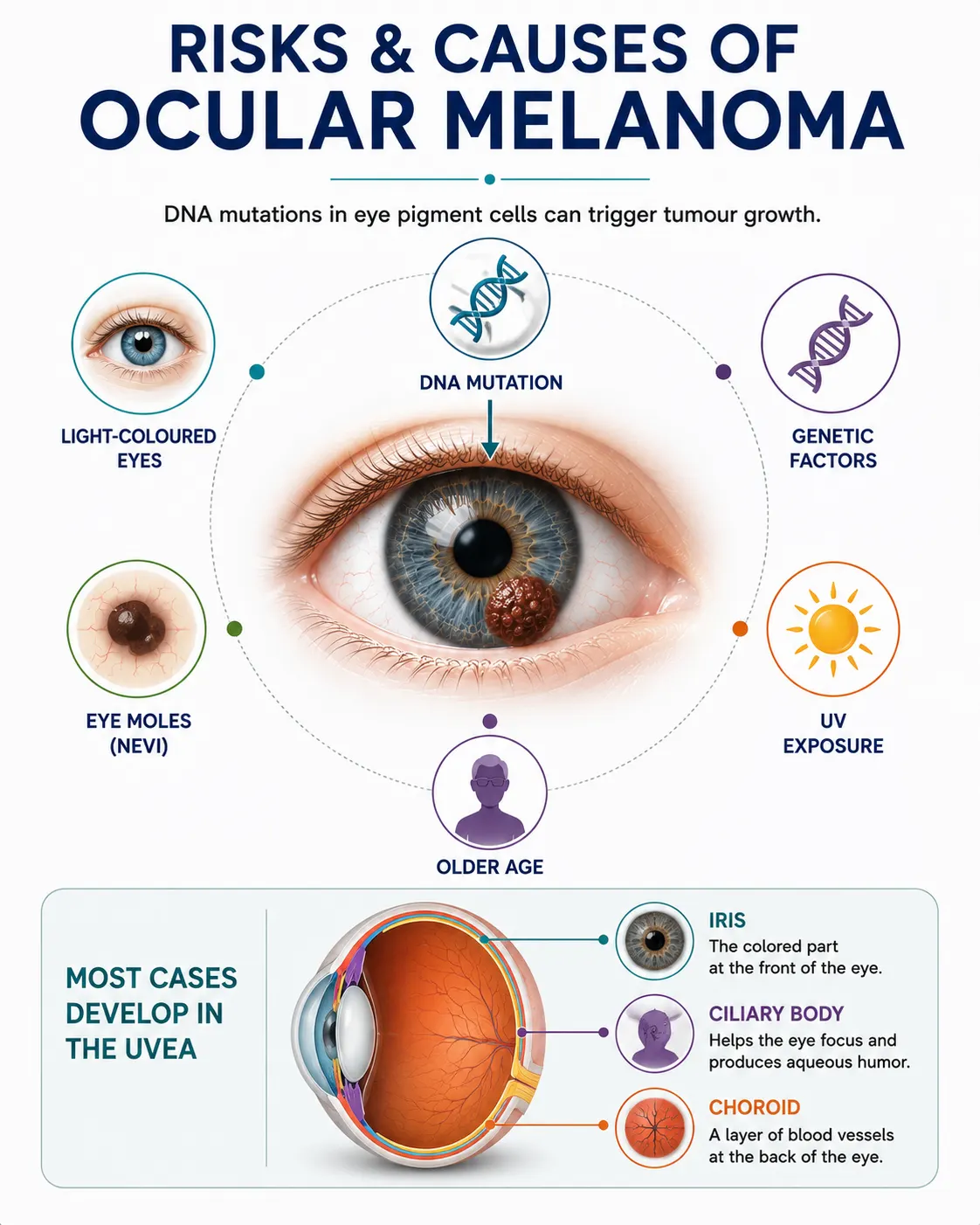 Infographic titled "Risks & Causes of Ocular Melanoma" with the subtitle "DNA mutations in eye pigment cells can trigger tumour growth." A central image shows a blue eye with a dark tumor on the iris, surrounded by six risk factor icons: light-coloured eyes, genetic factors, eye moles (nevi), UV exposure, older age, and DNA mutation. Bottom section shows an eye cross-section labeling the iris, ciliary body, and choroid, noting most cases develop in the uvea.